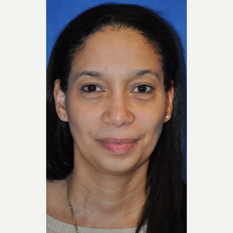 35-44 year old woman treated with African American Rhinoplasty after 3245965