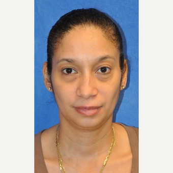 35-44 year old woman treated with African American Rhinoplasty before 3245965