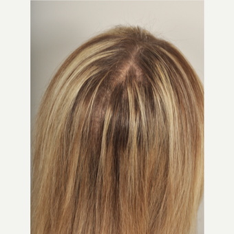 65-74 year old woman treated with PRP for Hair Loss after 3615622