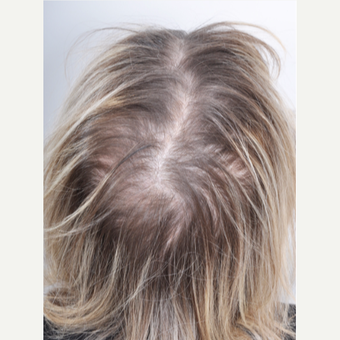 65-74 year old woman treated with PRP for Hair Loss before 3615622