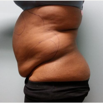 35-44 year old woman treated with Lipotherme before 3763948
