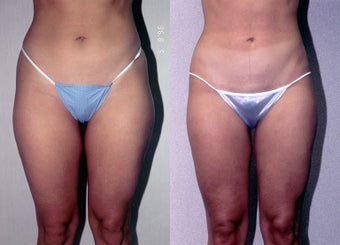 30-year-old woman treated with Liposuction. before 3287330