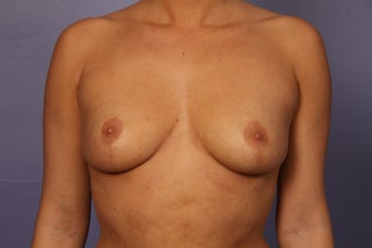 Breast Augmentation before 962033