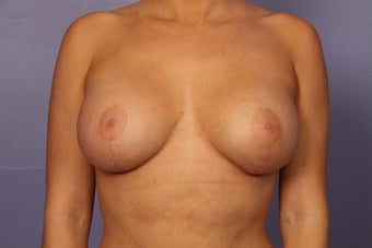 Breast Augmentation after 962033