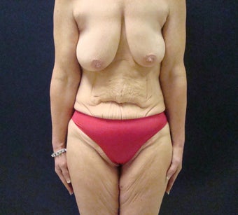 48-year-old female treated for loose, sagging skin before 1432614