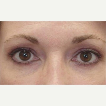 45-54 year old woman treated with Eye Bags Treatment after 1789636