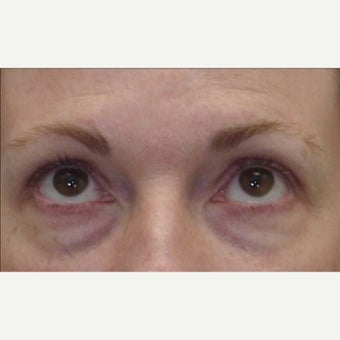 45-54 year old woman treated with Eye Bags Treatment before 1789636