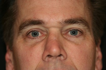 Tear Trough Rejuvenation male after 1142203