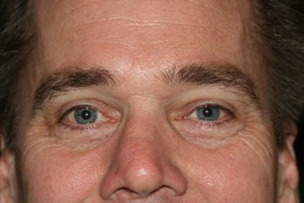 Tear Trough Rejuvenation male before 1142203