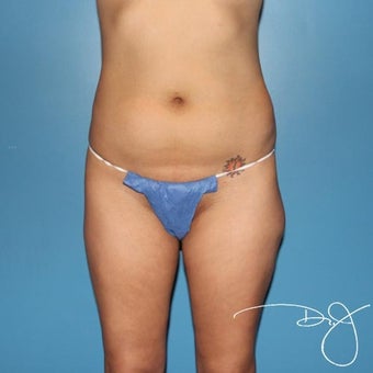 Liposuction with Contouring before 1414251