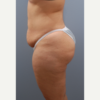 35-44 year old woman treated with Tummy Tuck before 3590102