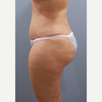 35-44 year old woman treated with Tummy Tuck after 3590102