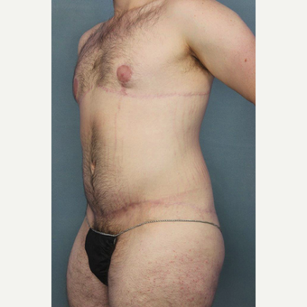 25-34 year old man treated with Body Lift after 3145368