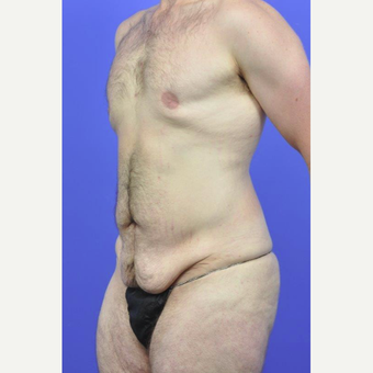 25-34 year old man treated with Body Lift before 3145368
