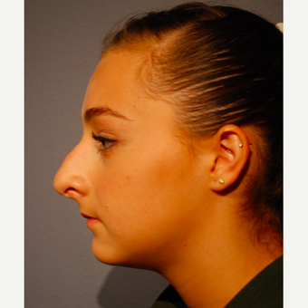 17 or under year old woman treated with Rhinoplasty before 3277653