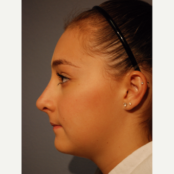 17 or under year old woman treated with Rhinoplasty after 3277653