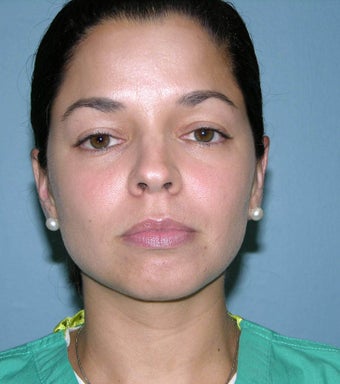 Rhinoplasty 1363161
