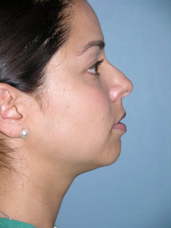 Rhinoplasty before 1363161