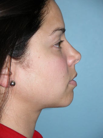 Rhinoplasty after 1363161