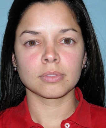 Rhinoplasty 1363161