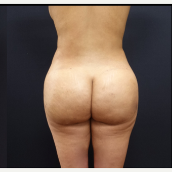25-34 year old woman treated with Brazilian Butt Lift after 3266937