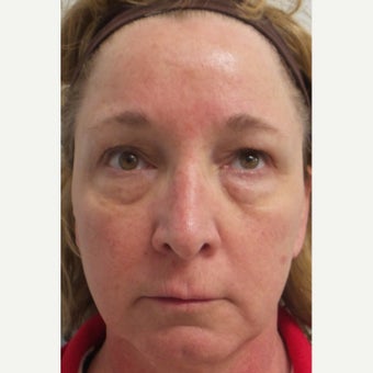 45-54 year old woman treated with Restylane before 1711678