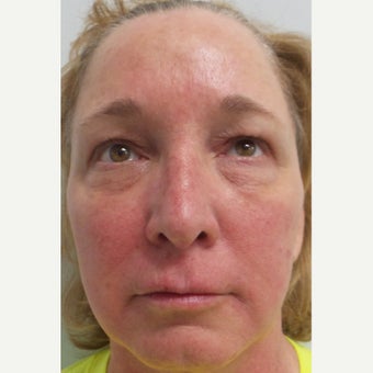 45-54 year old woman treated with Restylane after 1711678