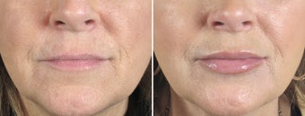Lip Augmentation before 739192