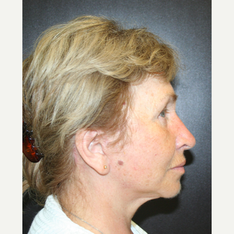 55-64 year old woman treated with SMAS Facelift after 3405706