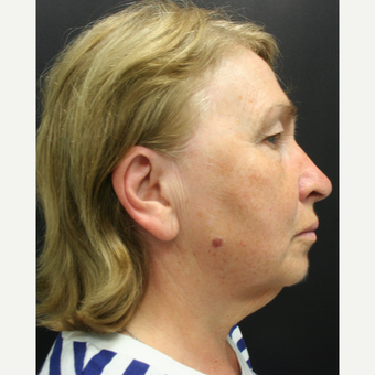 55-64 year old woman treated with SMAS Facelift before 3405706