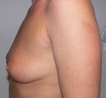 Breast Augmenation 943667