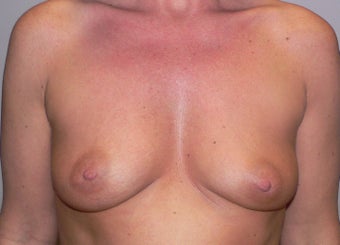 Breast Augmenation before 943667