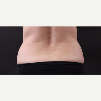55 year old woman treated with CoolSculpting after 3220721