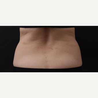 55 year old woman treated with CoolSculpting before 3220721