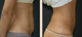 Abdominoplasty after 634415