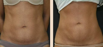 Abdominoplasty before 634415