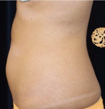 25-34 year old woman treated with CoolSculpting before 2052289