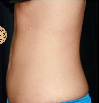 25-34 year old woman treated with CoolSculpting after 2052289