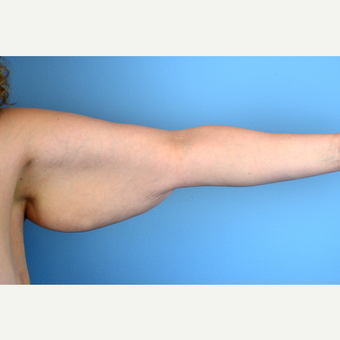 35-44 year old woman treated with Arm Lift before 3644189
