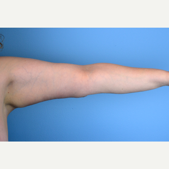 35-44 year old woman treated with Arm Lift after 3644189