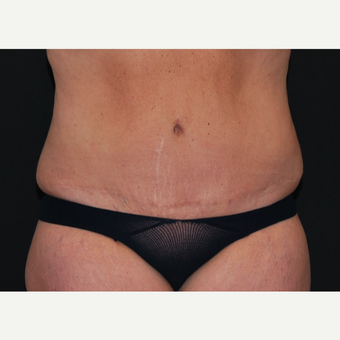 45-54 year old woman treated with Tummy Tuck after 3666052