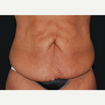 45-54 year old woman treated with Tummy Tuck before 3666052