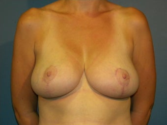 Bra size 34G with neck, back and should pain. after 1062554
