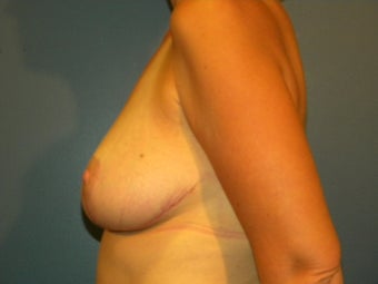 Bra size 34G with neck, back and should pain. 1062554
