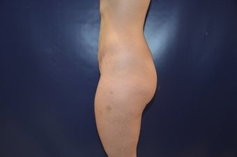 25 year-old female for Brazilian Buttock Augmentation before 1440203