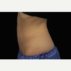 25-34 year old woman treated with CoolSculpting after 3770955