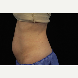 25-34 year old woman treated with CoolSculpting before 3770955