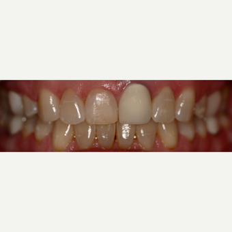 35-44 year old woman treated with Dental Crown before 3743717