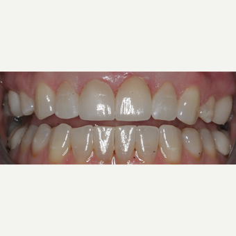 35-44 year old woman treated with Dental Crown after 3743717