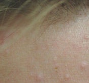 Laser treatments for Sebaceous Hyperplasia before 89121